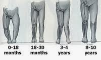 http://orthopedicsindia.com/deformity-correction-knock-knees-correction.html
