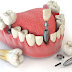 Trồng răng sứ bằng implant có hiệu quả không?