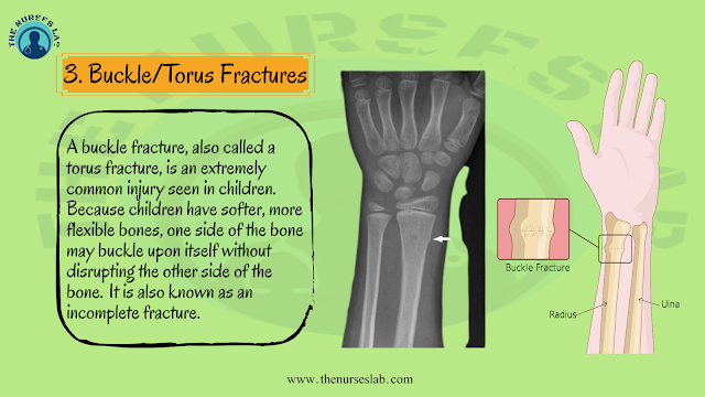 Types of Bone Fracture