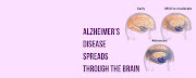 The Early, Mild to Moderate and Advanced stages of Alzheimer's in the brain.