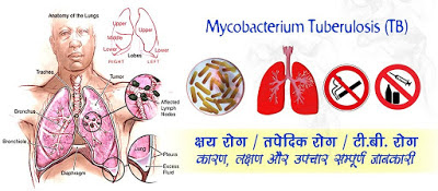 क्षय रोग के लक्षण कारण और उपचार, Tuberculosis Disease in Hindi क्षय रोग के लक्षण कारण और उपचार, Tuberculosis Disease in Hindi, माइकोबैक्टीरियम ट्यूबरक्लोसिस, टीबी के लक्षण, Tuberculosis (TB) Symptoms in Hindi, tv ke lakshan, तपेदिक, क्षय रोग, यक्ष्मा, टी.बी. कारण, tv ke karan, shay rog ke lakshan, क्षय रोग के कारण