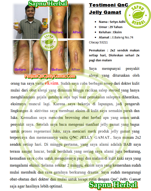 Cara Mengobati Eksim Kering Secara Alami Terbukti Mujarab ~ TESTIMONI QNC JELLY GAMAT Cara Mengobati Eksim Kering Secara Alami Terbukti Mujarab ~ TESTIMONI QNC JELLY GAMAT