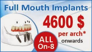 All on 8 Dental Implant Delhi India
