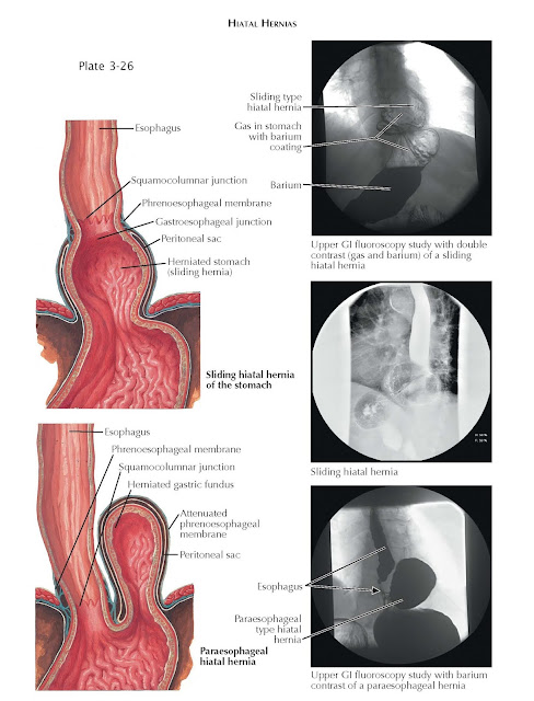 Sliding and Paraesophageal Hernia