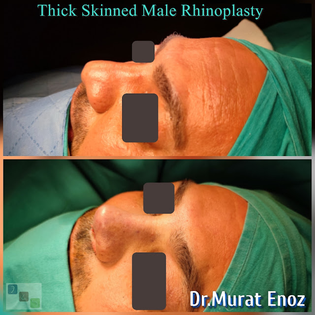 Male Rhinoplasty Operation For Thick Skinned Nose - Oily thick skinned nose job - Nose job for men Turkey