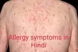 Anti Allergy Medicine In Hindi | LCZ TABLET USES IN HINDI |