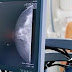 Estudo de câncer reacende debate sobre quando iniciar mamografias