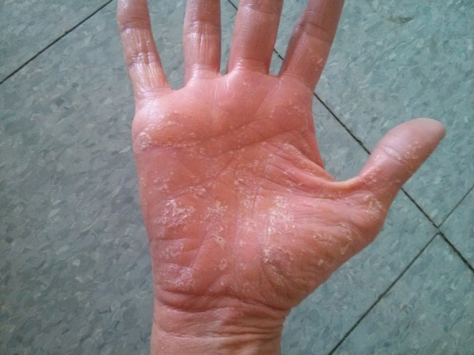 How I cured my dyshidrotic eczema on fingers