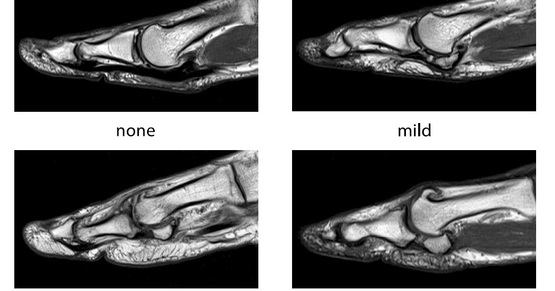 Professor Hylton B Menz Development of an MRI atlas for big toe arthritis