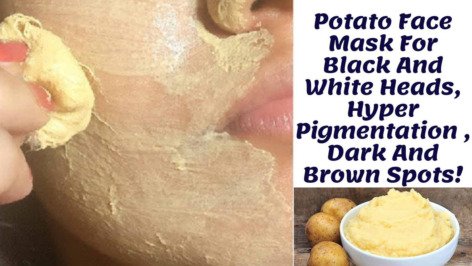 Potato Face Mask For Black And White Heads, Hyper Pigmentation , Dark