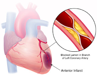 Clinical Manifestations of Myocardial Infarction