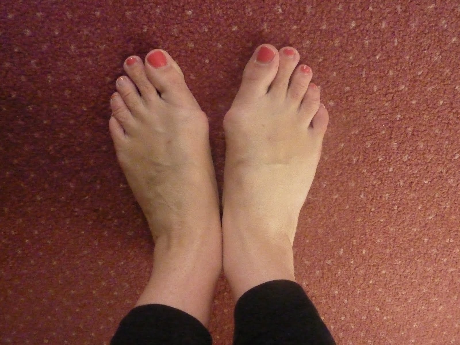 from-bunions-to-beautiful-feet-this-blog-ain-t-no-use-without-pictures