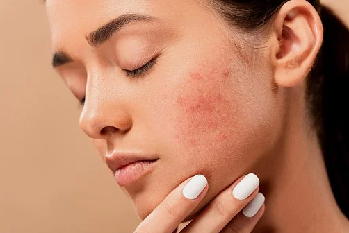 skincare untuk kulit berjerawat skincare untuk kulit berjerawat
