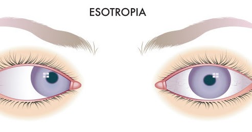 Management of Esotropia