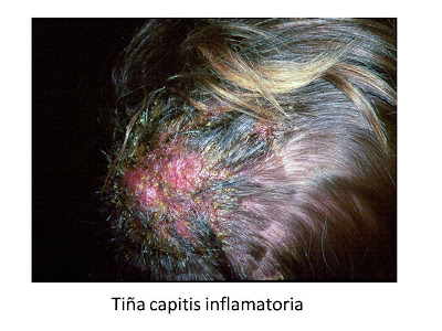 Tiña capitis inflamatoria