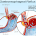 What Is Acid Reflux?