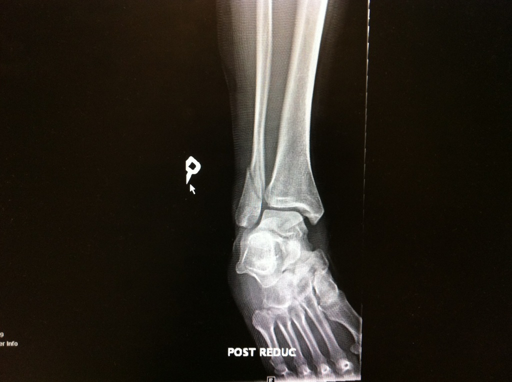 My Broken Ankle =( ER Broken ankle, fractured heel, dislocated, and
