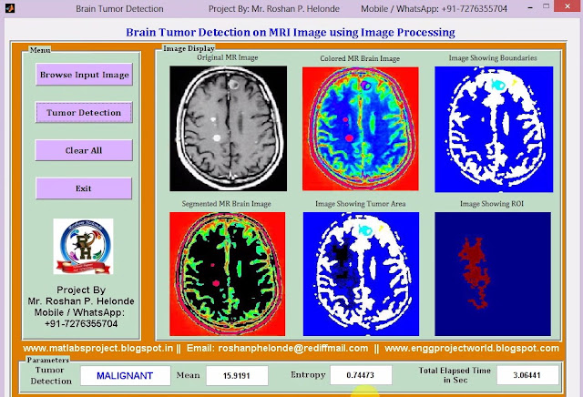 matlab-code-for-brain-tumor-detection-on-mri-images-using-image-processing-full-matlab-project