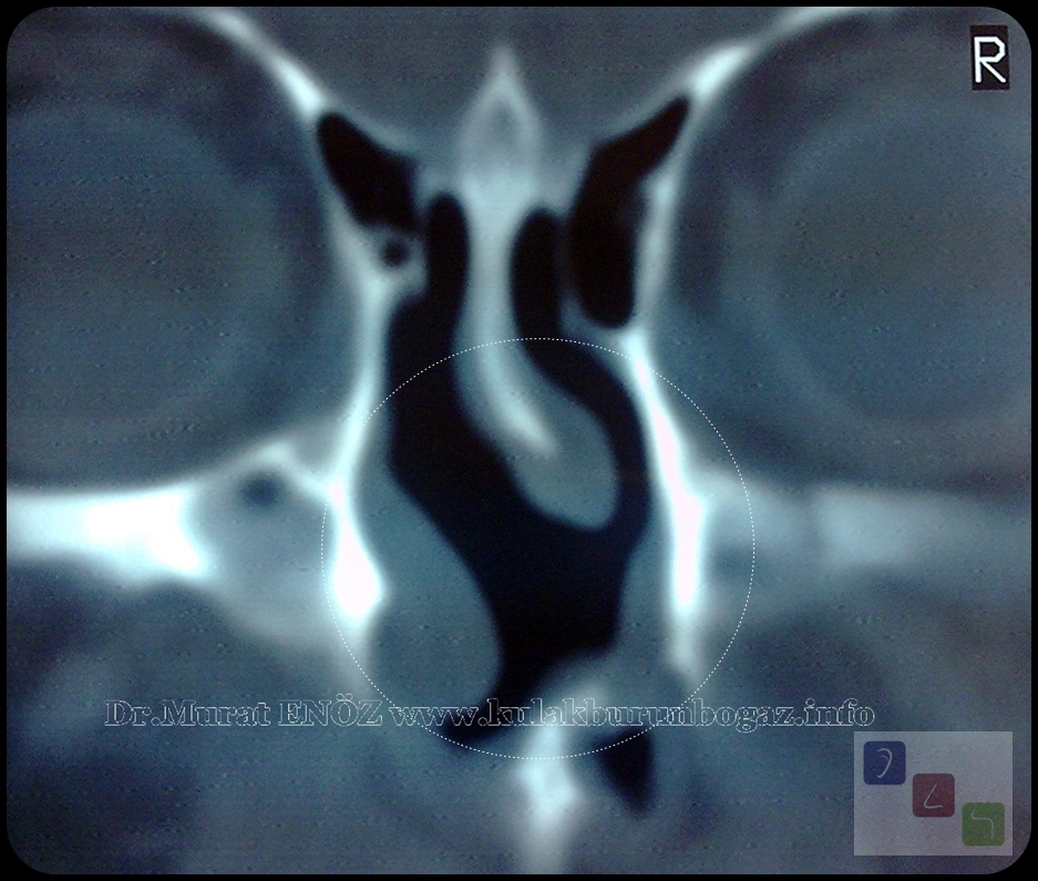 Nasal Septum Perforation Definition, Causes, Symptoms, Diagnosis and Treatment