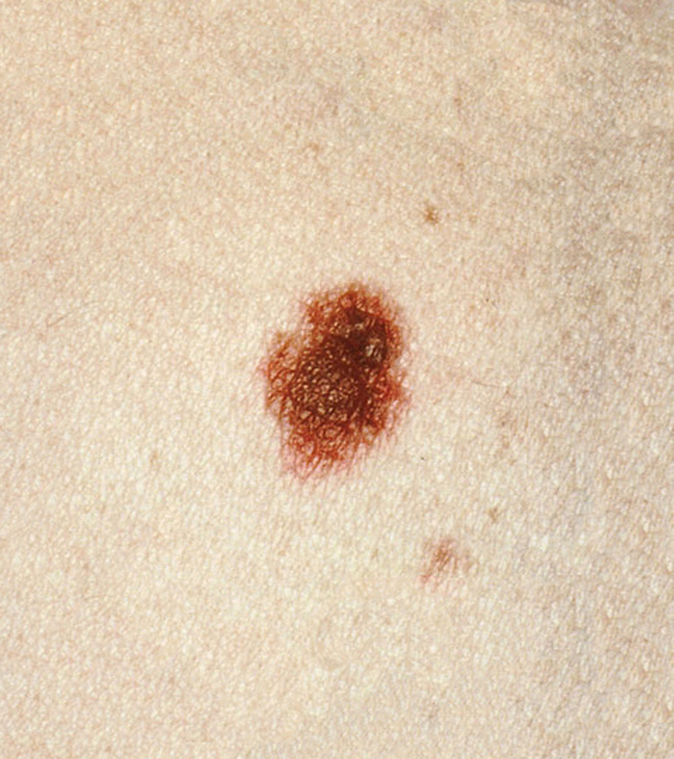 Common Moles, Dysplastic Nevi, and Risk of Melanoma ...