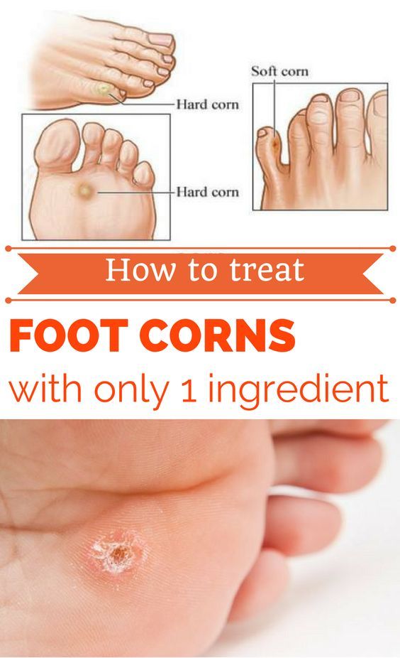 How To Get Rid Of Foot Corns With Only 1 Ingredient Wellness tab