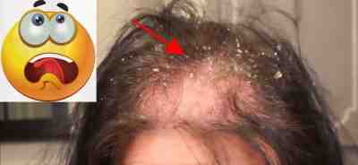 الثوم لانبات الشعر في مقدمة الراس الحل البديل ل زراعة الشعر