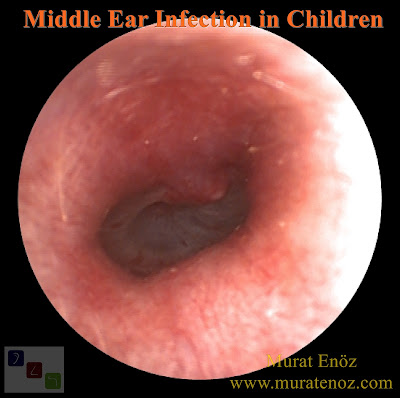Symptoms of Middle Ear Infection in Children - Where The Microbes Come From to The Middle Ear? - What Are The Symptoms Of Middle Ear Infection? - What Are The Protective Measures For Middle Ear Infection? - Treatment Of Middle Ear Infection?