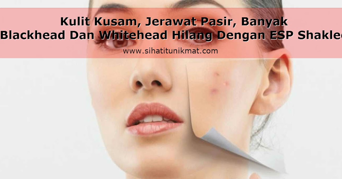 Kulit Kusam,Jerawat Pasir, Banyak Blackhead Dan Whitehead Hilang Dengan
