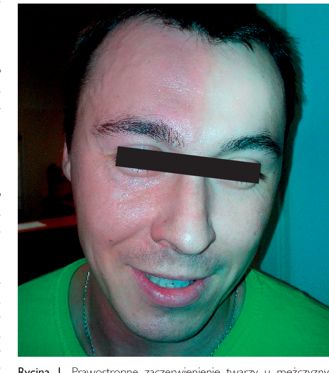 Harlequin Syndrome, Diagnosis, Symptoms and Treatment