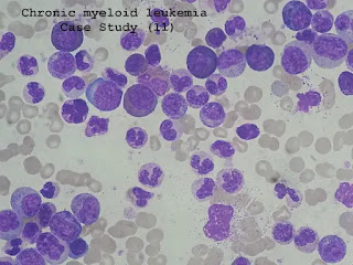 Case Study (11)- Chronic myeloid leukemia currently in remission