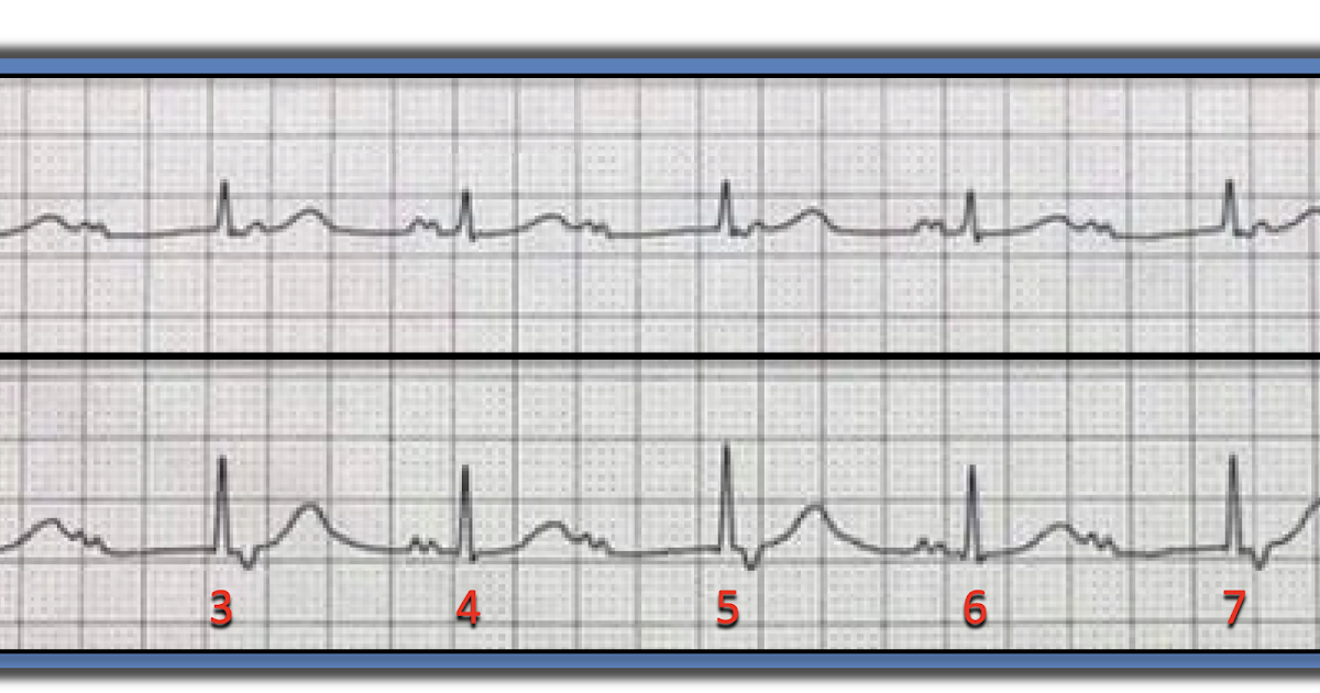 ECG Interpretation ECG Blog 239 (54) — Why 2 Kinds of P Waves?