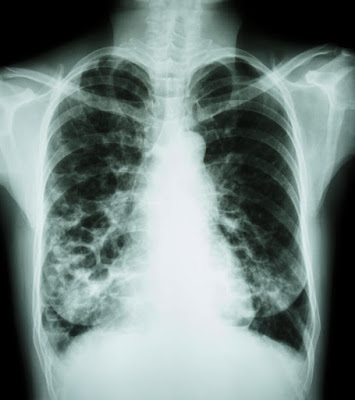 Paru-paru pengguna vape terkena bronkitis