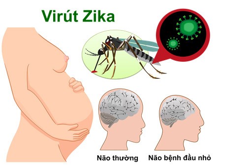 Người mẹ khi mang thai nếu mang trong mình viru Zika