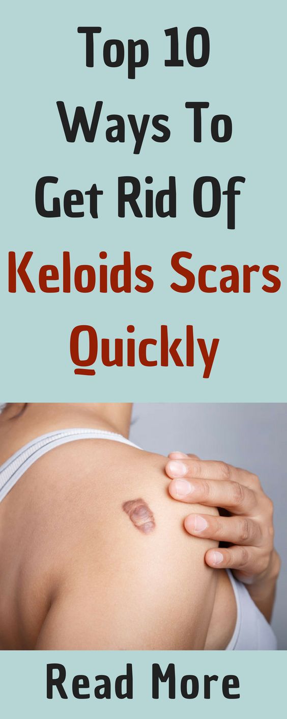 How To Get Rid Of Keloids TOP 5 DIY