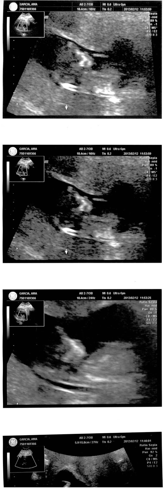 Luna Boricua Nuchal Translucency results