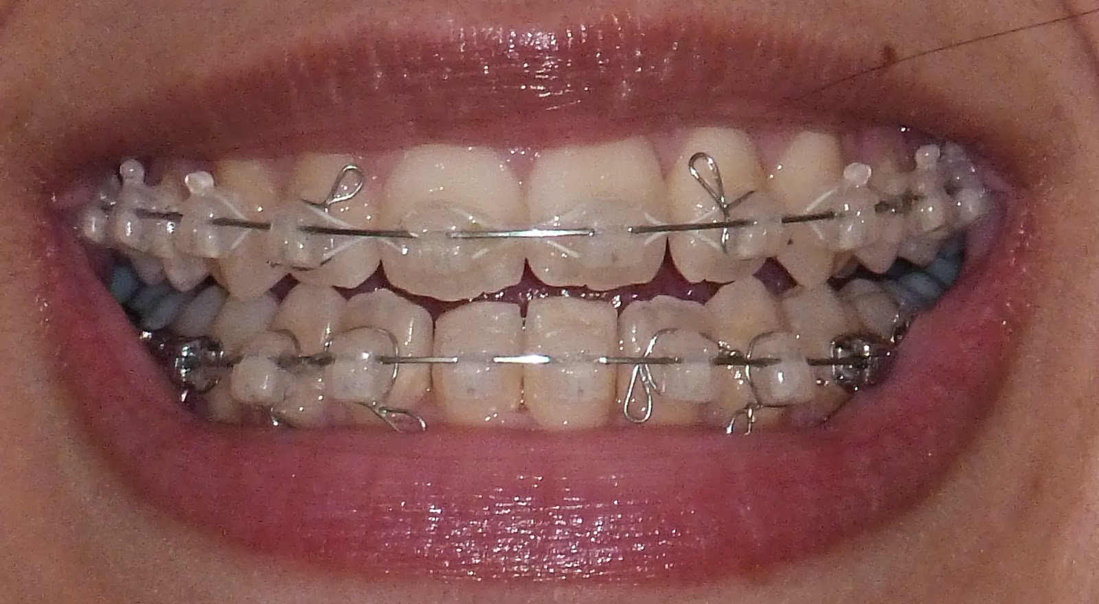 My Damon Clear Braces Week 30