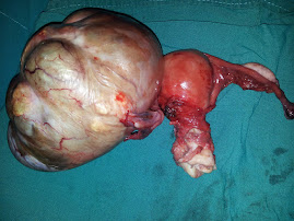 Right cystic ovarian tumor