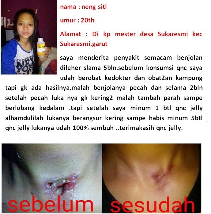 Obat Laringitis / Radang Pita Suara Akut Dan Kronis Tradisional ~ TESTIMONI JELLY GAMAT QNC Obat Laringitis / Radang Pita Suara Akut Dan Kronis Tradisional ~ TESTIMONI JELLY GAMAT QNC