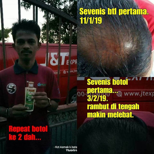 Asmak Testimoni Rambut lebat Rawat Rambut Gugur Dengan Asmak Hair Care