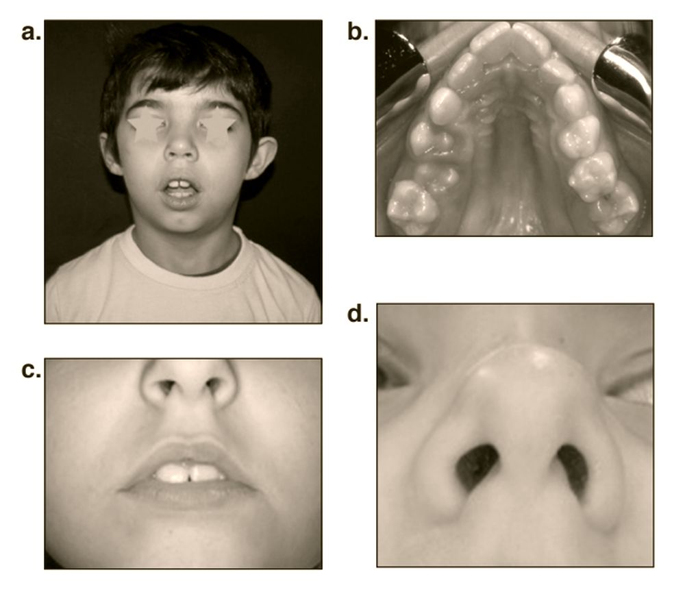 Oral breathing new early treatment protocol OdontoVida