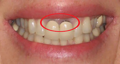 Nguyên nhân khiến răng sứ bị đen viền nướu 