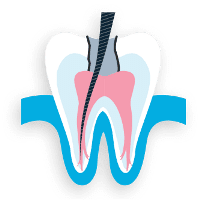 Root canal treatment