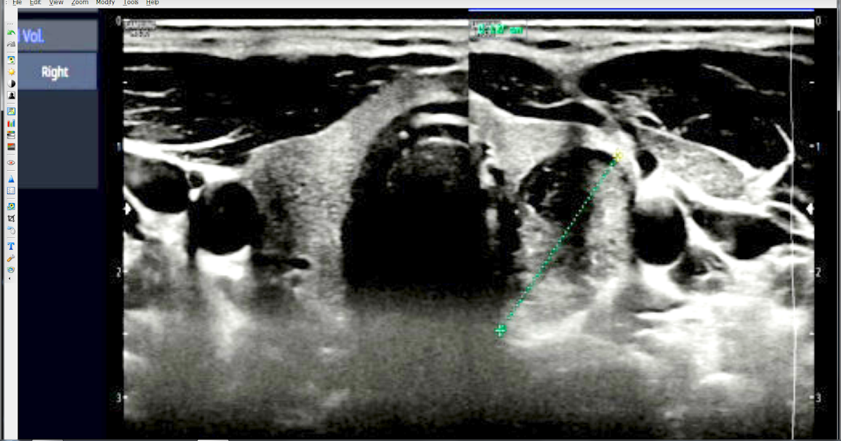 VIETNAMESE MEDIC ULTRASOUND CASE 561 THYROID CANCER, Dr PHAN THANH HAI, MEDIC MEDICAL CENTER