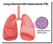 penularan tbc