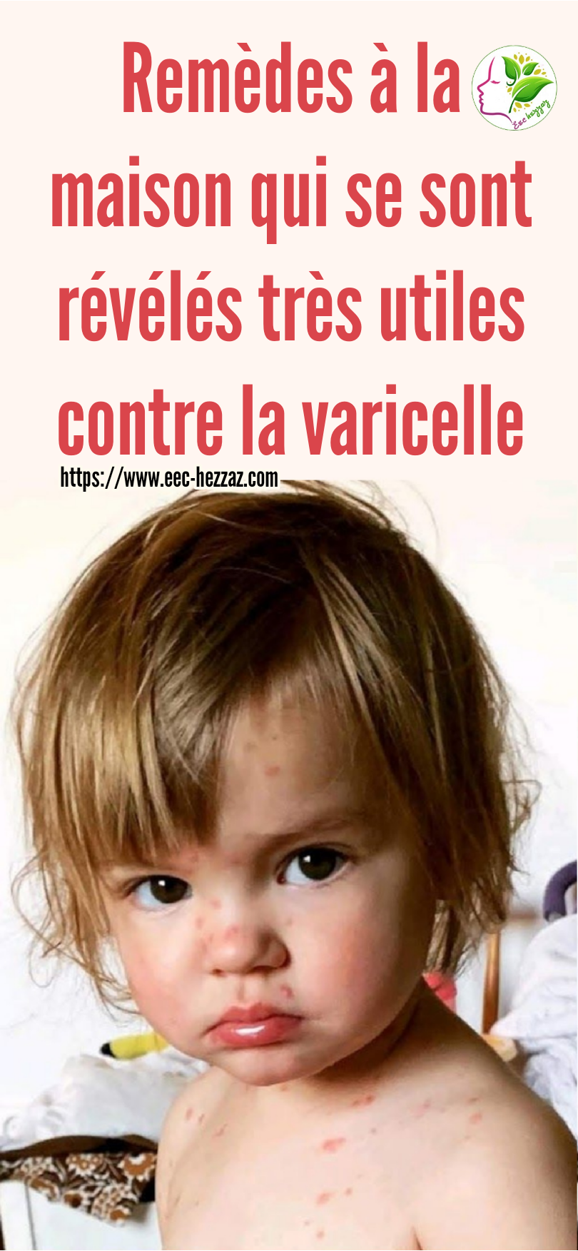 Remèdes maison qui se sont révélés très utiles contre la varicelle