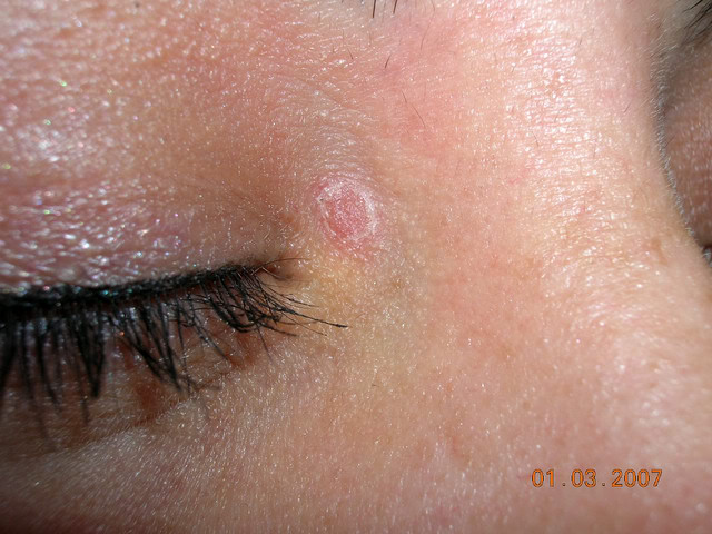 Eyelid Psoriasis Treatment