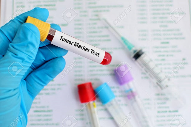 Apa Perasaan Bila Tumor Marker di Jumpai dalam Darah anda ?