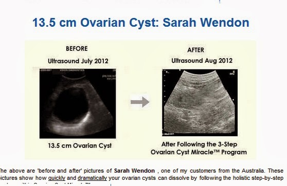 45++ 9 Cm Ovarian Cyst at Demax1