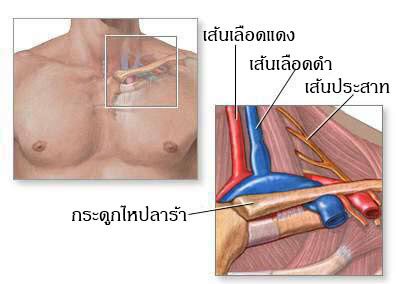 thoracic outlet syndrome อาการ full