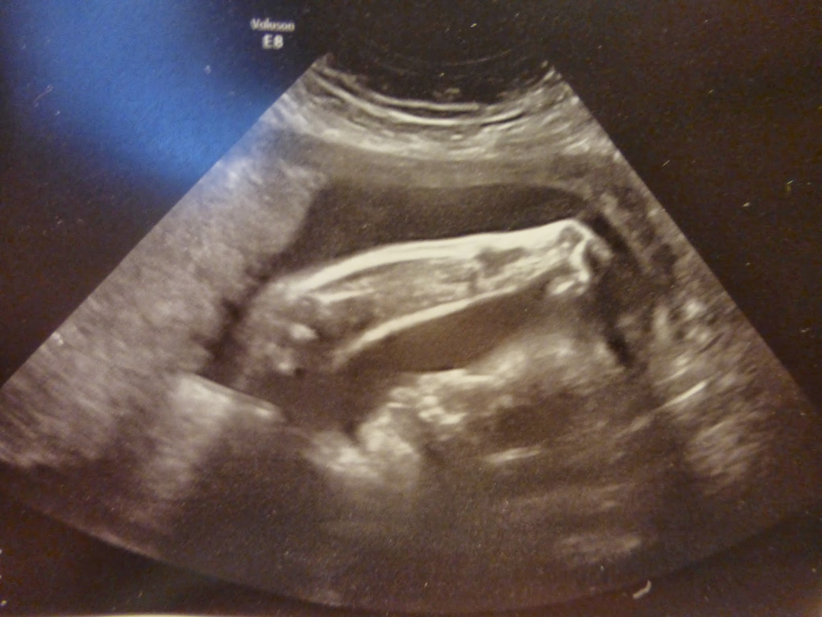 Cherishing Elise Carrying and Loving Our Trisomy 18 Baby 35 weeks